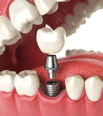 dental implants straumann dentist